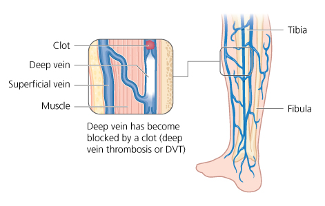Deep vein thrombosis (DVT)